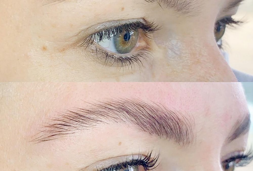 Brow Lifting